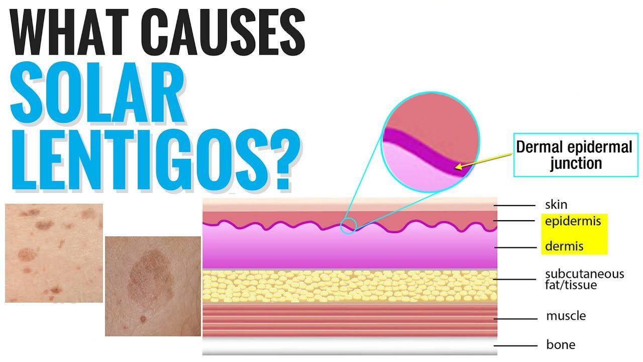 孚立美“氟轻松氢醌维A酸乳膏”能用于老年斑治疗吗？