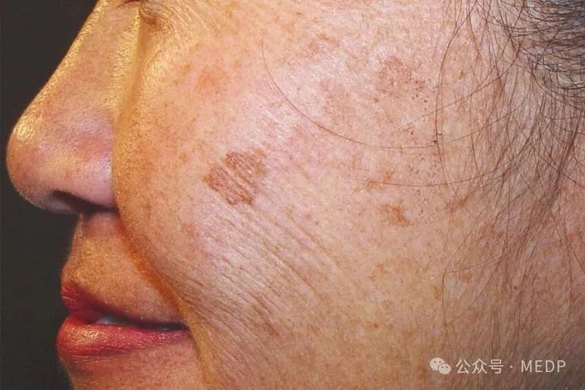 老年斑、晒斑、日光性雀斑是一回事吗？